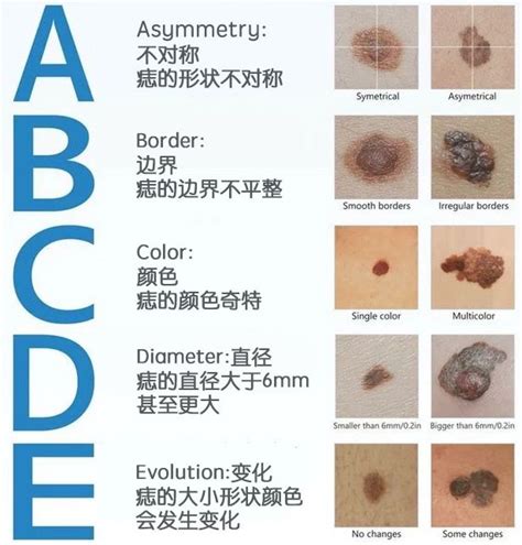 不規則黑痣|非典型痣